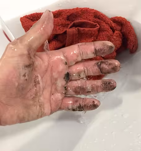 Katy Emslie’s badly burnt hand, which resulted from trying to extinguish a flaming EE Power Bar.