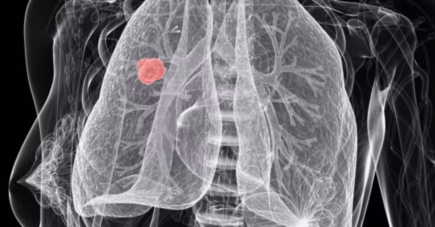 Scientists are using AI to predict which lung cancer patients will relapse