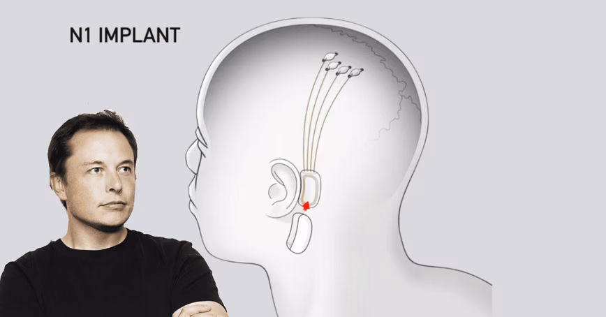 Neuralink: brain hacking is exceptionally hard, no matter what Elon Musk says