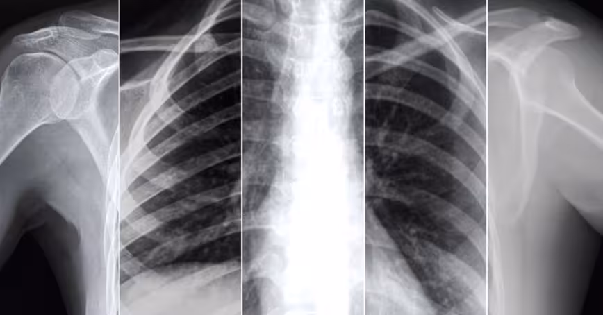 New self-supervised AI models scan X-rays to predict prognosis of COVID-19 patients