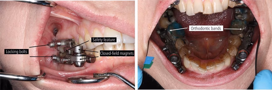 Design of the DentalSlim device