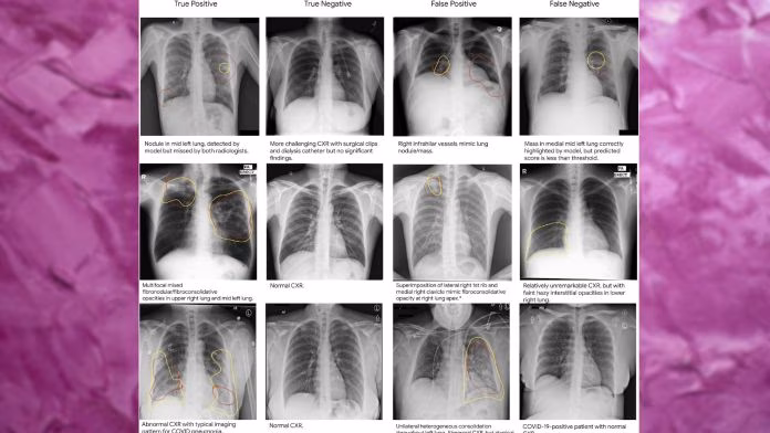 Chest X-Ray